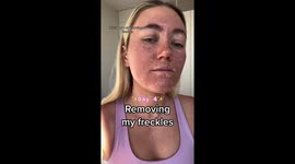 'I paid £1,400 to remove my FRECKLES – it felt like the worst sunburn of my life' PART 2/6