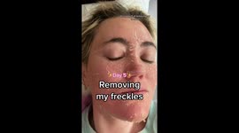 'I paid £1,400 to remove my FRECKLES – it felt like the worst sunburn of my life' PART 3/6