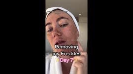 'I paid £1,400 to remove my FRECKLES – it felt like the worst sunburn of my life' PART 4/6