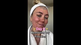 'I paid £1,400 to remove my FRECKLES – it felt like the worst sunburn of my life' PART 5/6