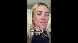 'I paid £1,400 to remove my FRECKLES – it felt like the worst sunburn of my life' PART 6/6