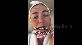 'I paid £1,400 to remove my FRECKLES – it felt like the worst sunburn of my life!'
