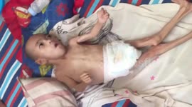 Boy, 6, still looks like baby due to rare disorder