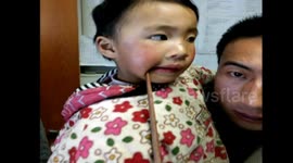 Chopstick enters toddler's skull through her mouth in nasty accident