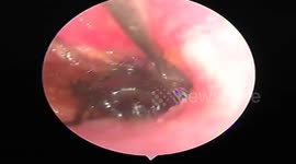 The doctor removes the bee that is attacking the man's ear canal