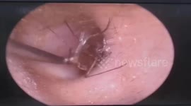 Mosquito removed from man's EAR in skin-crawling footage