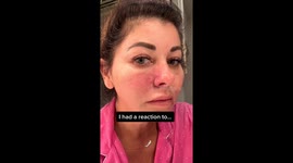 Woman with ‘face falling off’ after anti-ageing treatment warns against using filler