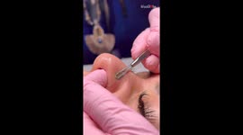Pro esthetician displays extremely satisfying skin-cleaning skills