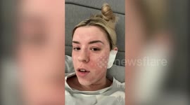 Woman with eczema says she looked like acid victim after quitting steroid cream