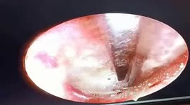 Jiminy! Live CRICKET pulled out of woman’s ear