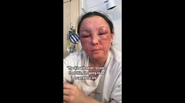 ‘My face swelled up and I lost my vision for days’ says woman suffering from traumatic skin condition