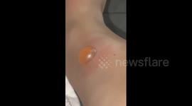British woman's holiday 'ruined' by insect bite swelling to size of GOLF BALL