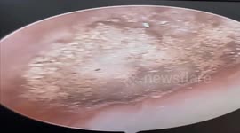 Doctor removes dozens of MUSHROOMS found growing inside patient's ear
