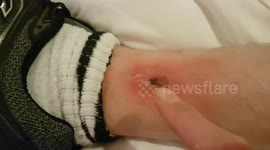 False widow spider Bites my Ankle and leaves a big infected hole and swelling