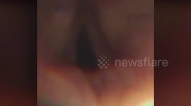Woman complaining over soar throat has three-inch LEECH in her windpipe