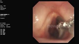 Doctors remove leech from woman's throat in China
