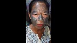 Filipino woman's face covered in black patches from cheap whitening creams