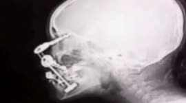 太原:11岁女孩钥匙不慎扎进眼 经抢救眼球保住了