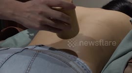 Bamboo cupping treatment uses wood instead of glass cups for alternative treatment
