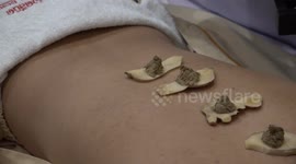 Woman enjoys 'moxibustion' alternative therapy at clinic in Bangkok