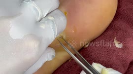 Doctor removes glass stuck in patient's foot for over FIVE years