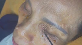 Dermatologist removes giant pimple in woman's eyelid
