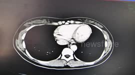 Doctor removes 14 weeks' baby from pregnant woman's liver successfully