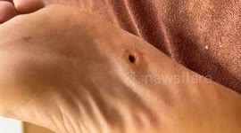 Ewww! Vietnamese dermatologist removes GIANT pimple from man's foot