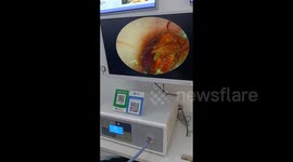 Live cockroach found in man's ear during cleaning in China