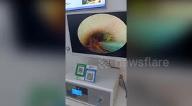 Doctors find giant cockroach wriggling inside a patient's ear
