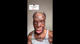 ‘I have burn scars on 90% of my body – my love life is non-existent' (Pt 2)