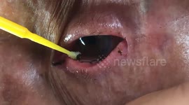 The doctor removed a 15 cm-long parasitic tapeworm from the woman's eye