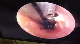 Vietnames doctor removes large plant growing inside man's ear
