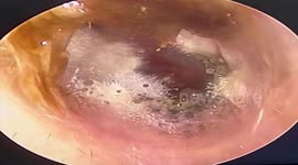 Doctor finds thousands of tiny mushrooms growing inside patient's ear