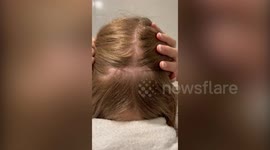 Identical twin has two hair transplants so hairline matches sister's - and it cost £5.5k