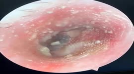 Dozens of small bugs live in the man's ear canal