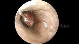 Chinese doctor successfully extracts pregnant cockroach from man's ear