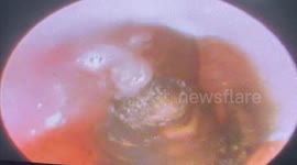 Huge bee removed from patient's ear in Vietnam