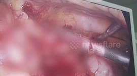 Shocked surgeons remove five-inch metal barbecue skewer stuck in man's intestines