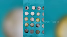 Doctors remove coins, magnets from 26-year-old's stomach in northern India