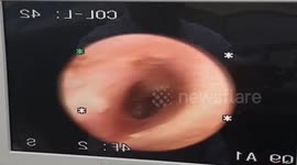 Fly extracted from patient's EAR in Vietnam