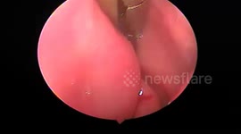 Doctor removes giant leech living in six-year-old boy's nasal canal