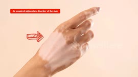 Vitiligo - Causes, Pathogenesis, Signs & Symptoms, And Treatment
