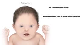 Down Syndrome - Signs & Symptoms (Clinical Features), And Long-Term Complications