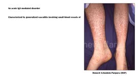 Henoch Schoenlein Purpura (HSP) - Causes, Pathophysiology, Diagnosis, And Treatment
