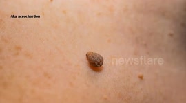 Skin Tags (Acrochordon) - Causes, Signs & Symptoms, And Treatment