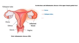 Pelvic Inflammatory Disease (PID) - Causes, Signs & Symptoms, Diagnosis, And Treatment