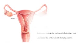Endometrial Cancer - Causes, Risk Factors, Signs & Symptoms, Staging, Diagnosis & Treatment
