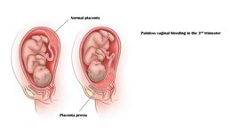 Placenta Previa - Causes, Risk Factors, Signs & Symptoms, Diagnosis, And Treatment