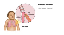 Understanding The Basics On Bronchiolitis - Causes, Signs & Symptoms, Diagnosis, Treatment